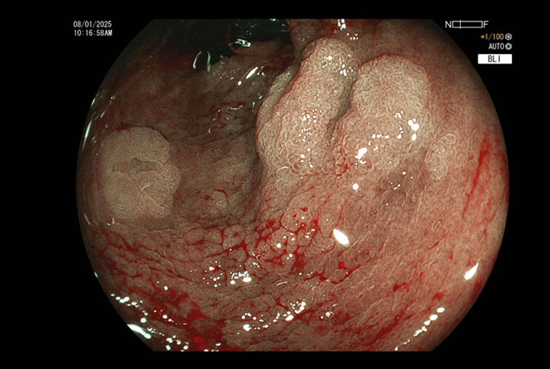 Case report: Underwater cold snare